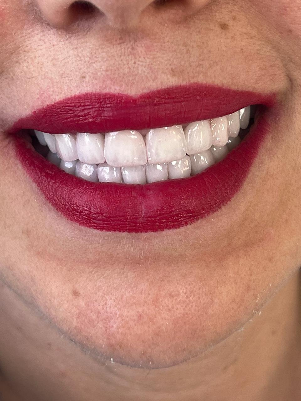 Dental Prosthetics
